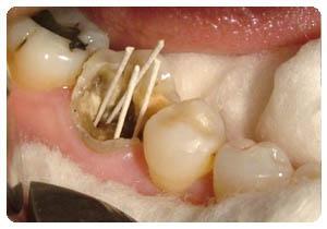 首页> 健康常识 > 龋齿牙医告诫说:"病变已经破坏到了牙本质深层,牙齿