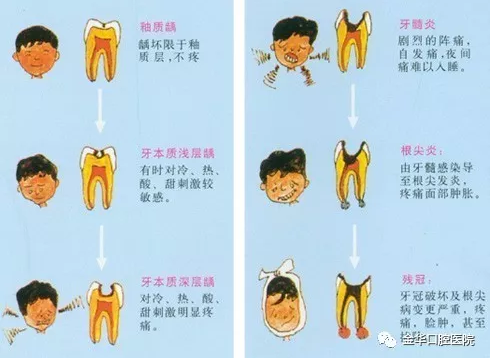 蛀牙的发展历程像小朋友尤其喜爱甜食,像糖果,巧克力等,这些黏性大的